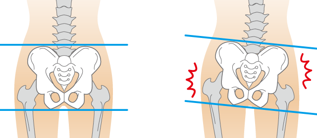 骨盤の歪みは内臓を圧迫し、便秘の原因になります。