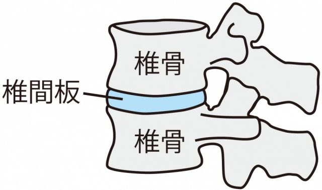 腰椎椎間板ヘルニアとは?